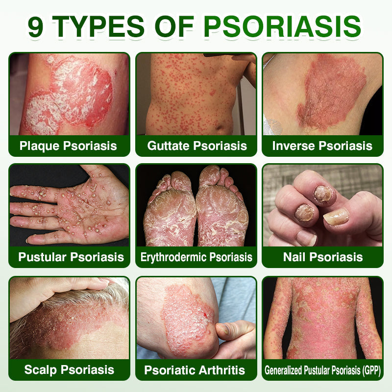 🛖💵GLIMMERLY® SkinRecovery Reishi Psoriasis Repair Spray