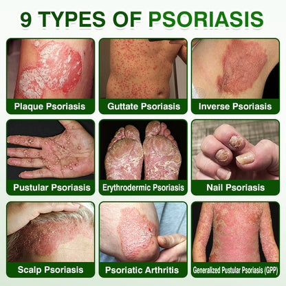 🛖💵GLIMMERLY® SkinRecovery Reishi Psoriasis Repair Spray
