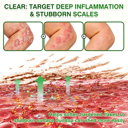 🛖💵GLIMMERLY® SkinRecovery Reishi Psoriasis Repair Spray