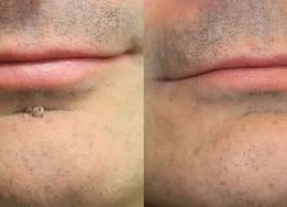 𝑮𝒂𝒇𝒂𝒄𝒆®2-in-1 Microneedle & Hydrocolloid Patch🍀| Removes Raised Moles, Acne, Flat Warts & Skin Tags | Helps Improve Wrinkles, Scars & Blemishes | Invisible Patches for Face & Body