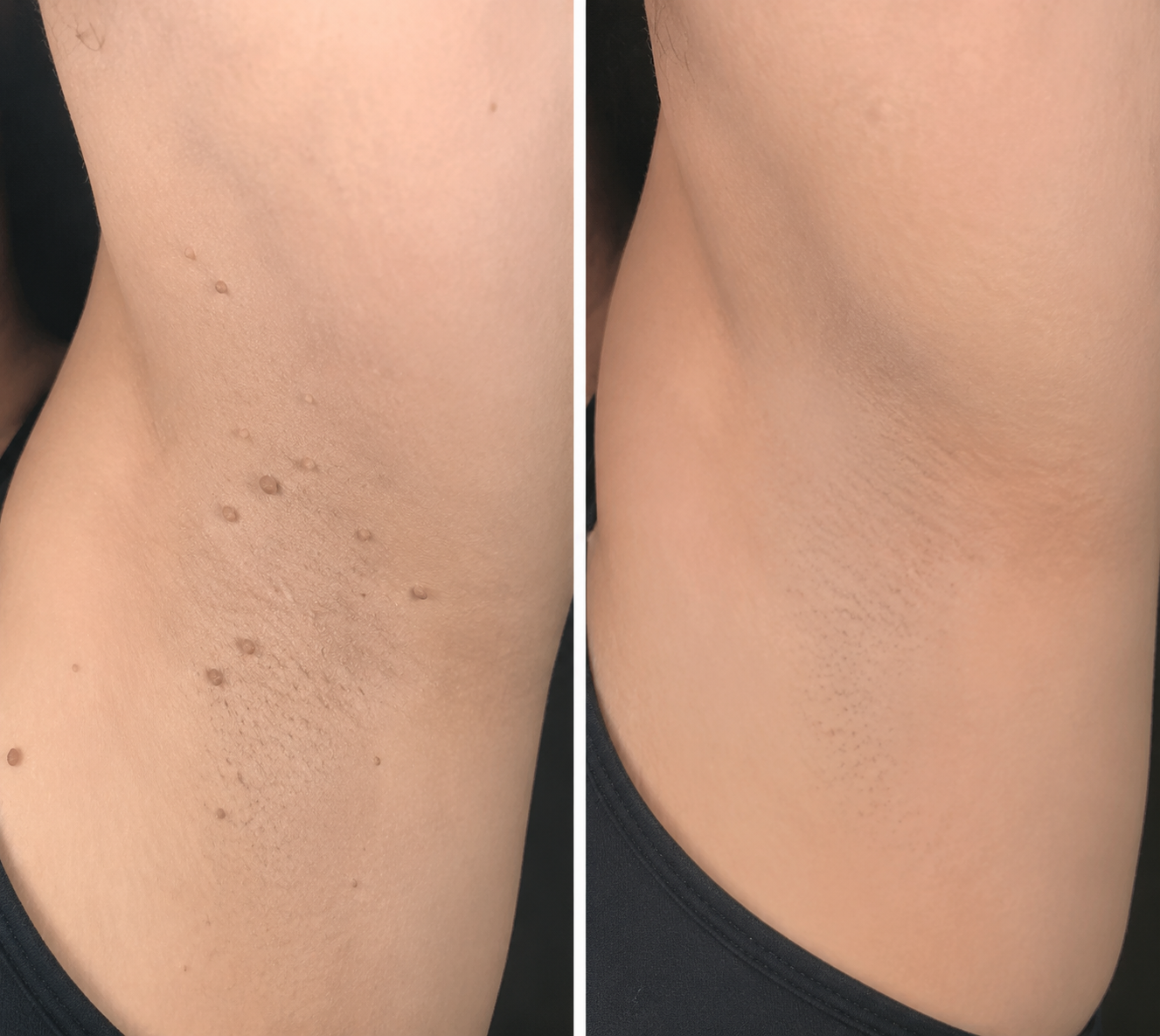 𝑮𝒂𝒇𝒂𝒄𝒆®2-in-1 Microneedle & Hydrocolloid Patch🍀| Removes Raised Moles, Acne, Flat Warts & Skin Tags | Helps Improve Wrinkles, Scars & Blemishes | Invisible Patches for Face & Body