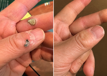 𝑮𝒂𝒇𝒂𝒄𝒆®2-in-1 Microneedle & Hydrocolloid Patch🍀| Removes Raised Moles, Acne, Flat Warts & Skin Tags | Helps Improve Wrinkles, Scars & Blemishes | Invisible Patches for Face & Body